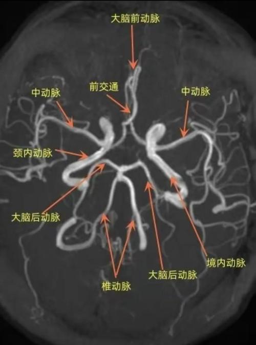 脑梗是梗动脉还是静脉