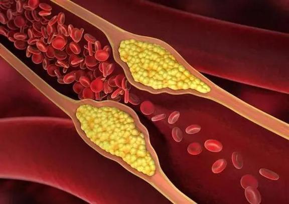 脑梗是梗动脉还是静脉