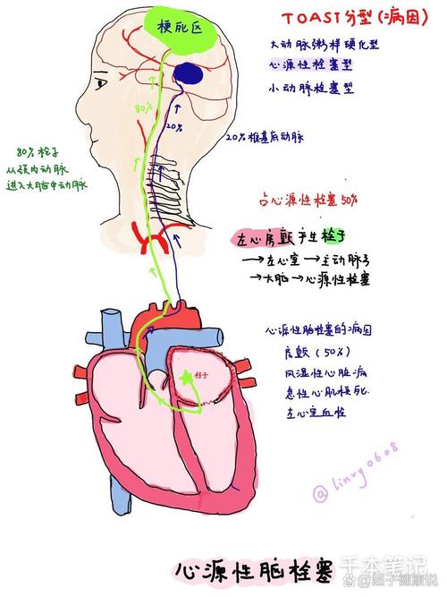 脑梗是梗动脉还是静脉