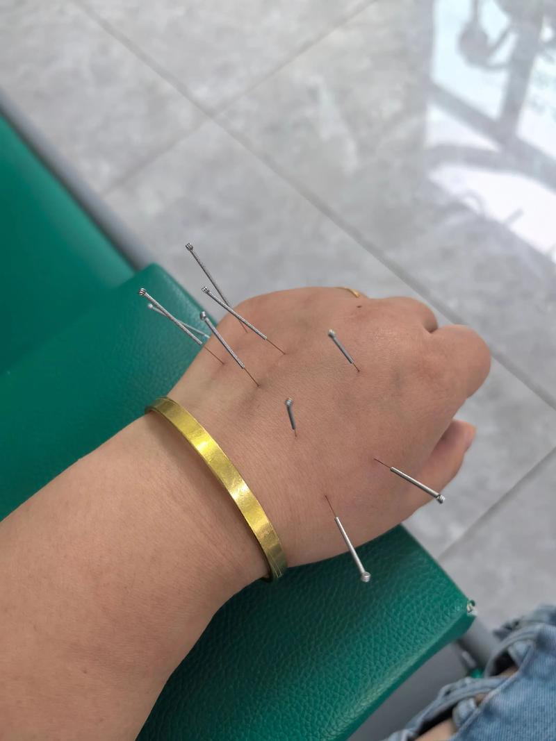 脑梗心梗针灸急救针灸