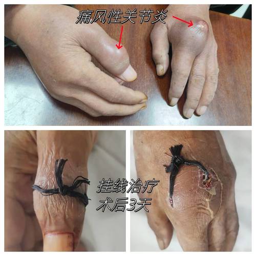 治疗老年风湿性关节炎