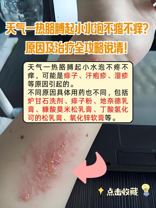 长效青霉素预防风湿热