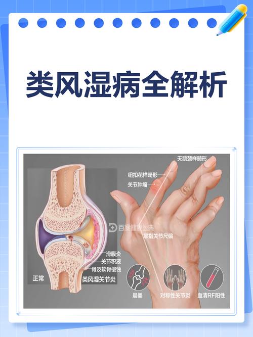 类风湿关节炎最怕什么