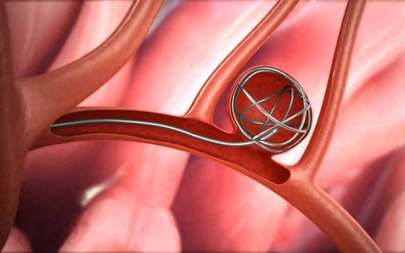 心梗加脑梗 不能支架