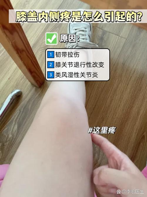 我类风湿膝盖肿两年了