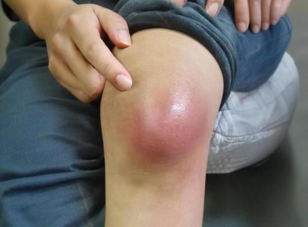 我类风湿膝盖肿两年了