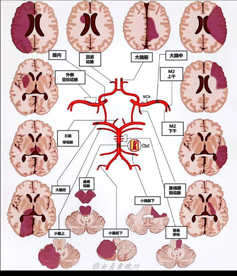 脑梗梗的都有什么部位