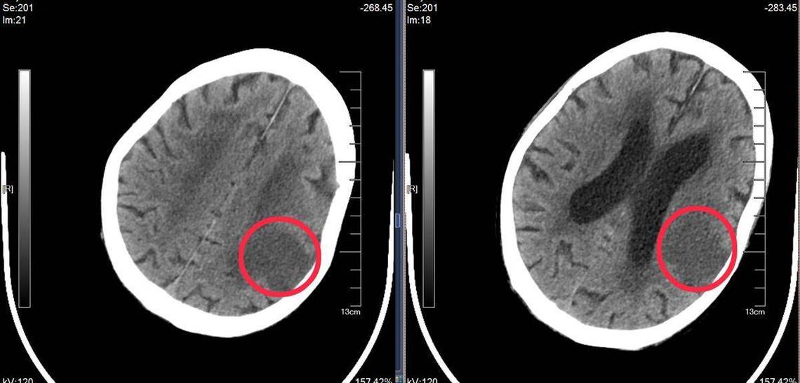 脑ct查出脑梗是什么
