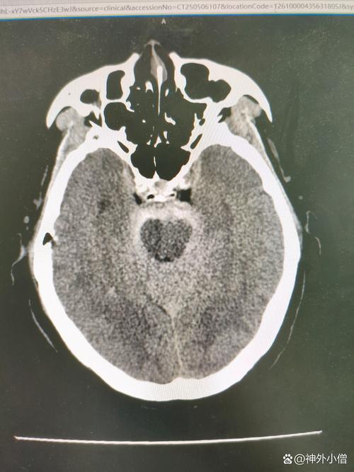 脑梗脑疝术后肺部感染