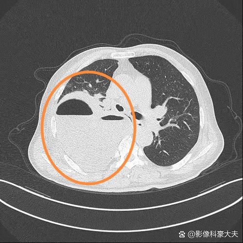 脑梗脑疝术后肺部感染