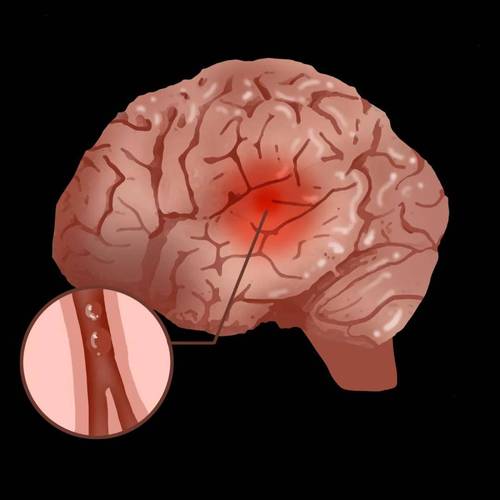 腔梗轻微脑梗 脑损伤