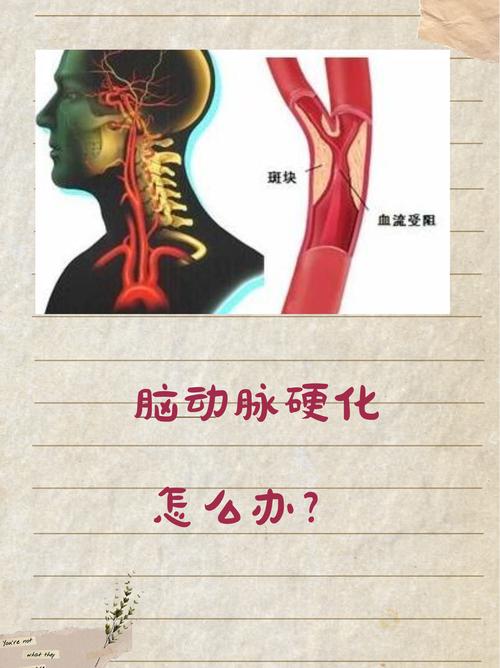 脑梗 腔梗 动脉硬化