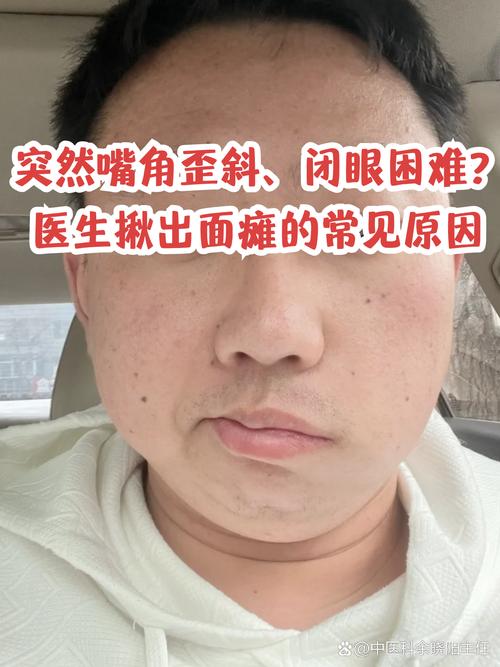 心梗脑梗病人嘴角发麻