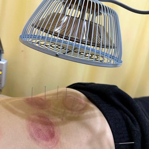 风湿性心脏病能针灸吗