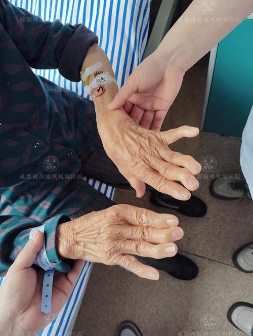 风湿性关节炎治疗视频