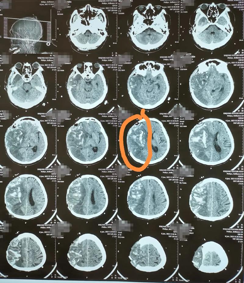 心梗支架术后突发脑梗