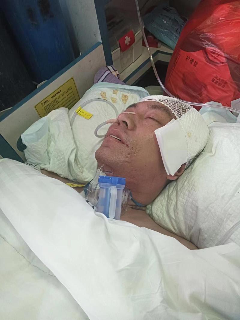 中风脑梗半脑坏死开颅