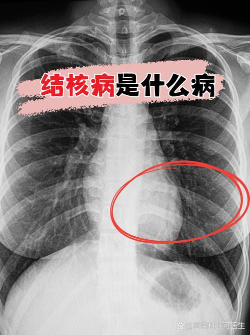 风湿性肺结核是什么样