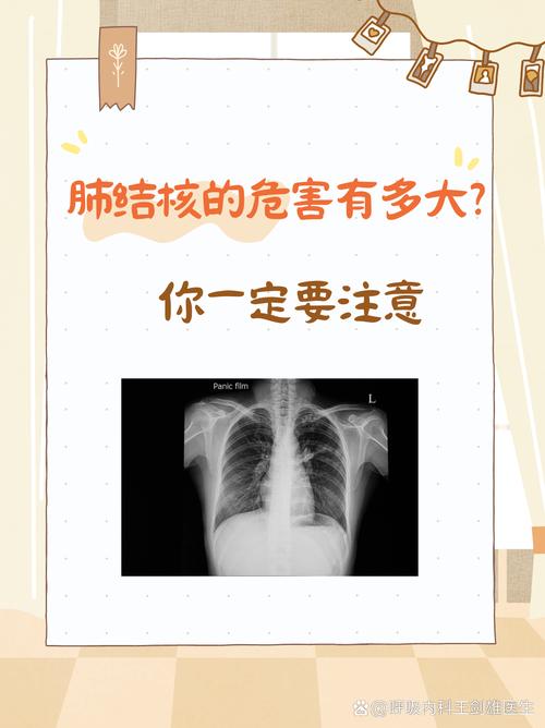 风湿性肺结核是什么样