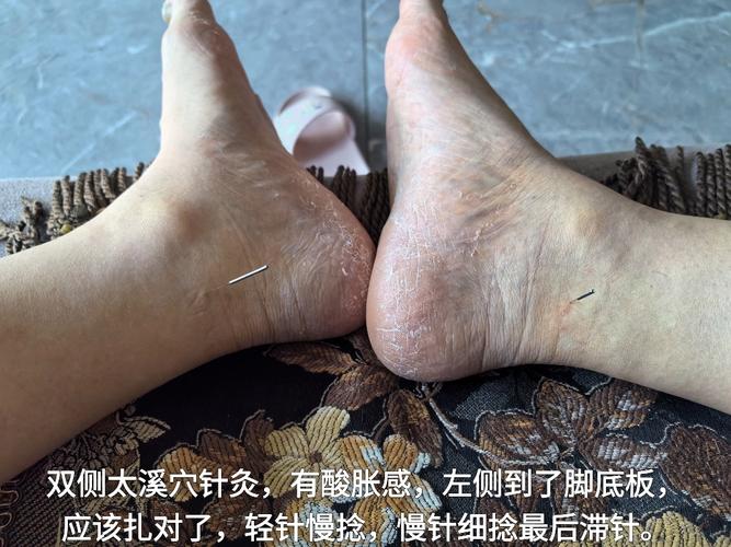 降尿酸针灸什么穴位