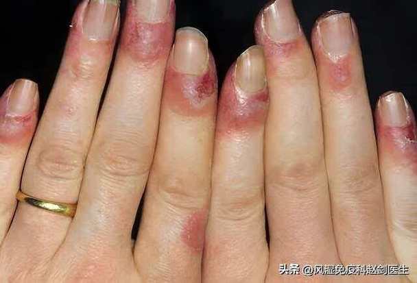 风湿性血管炎是什么病