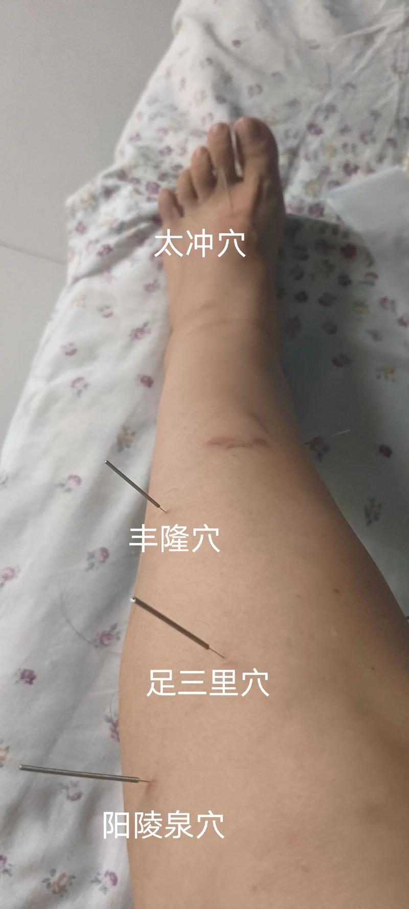 脑出血穴位针灸麻木