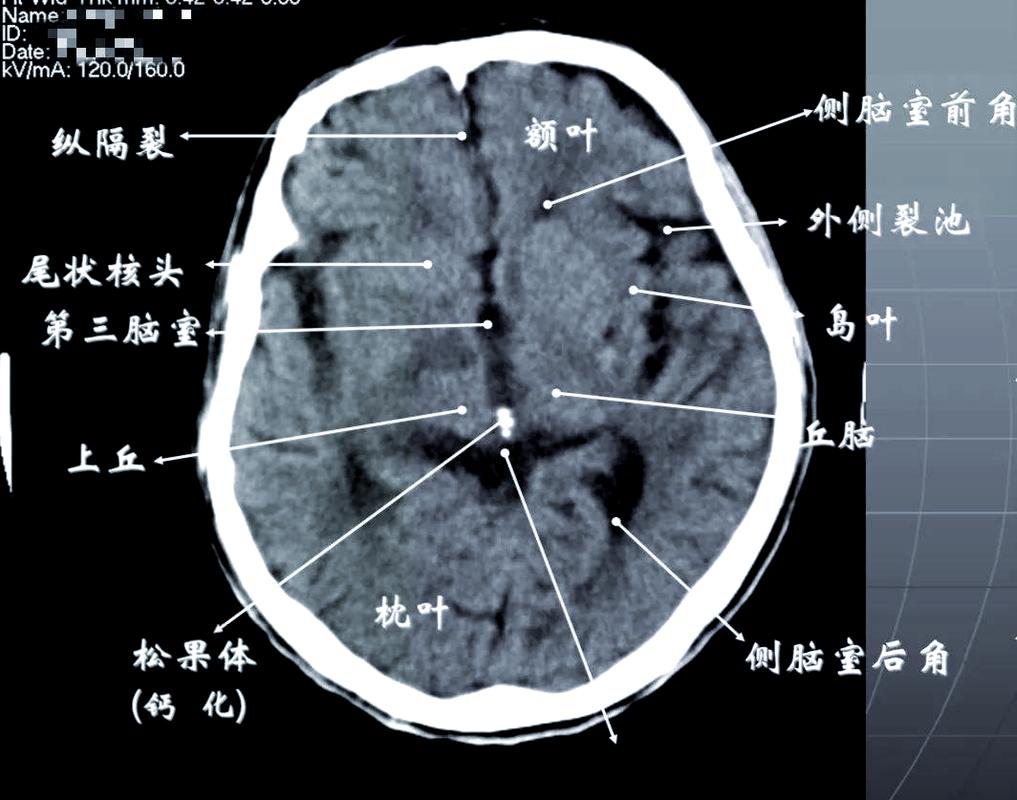 如何看懂脑梗脑ct图