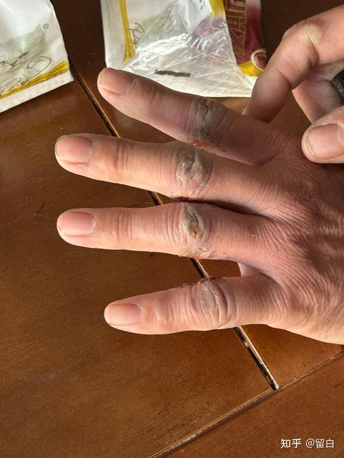 胡盛义类风湿真的假的