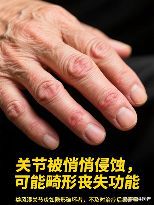 胡盛义类风湿真的假的