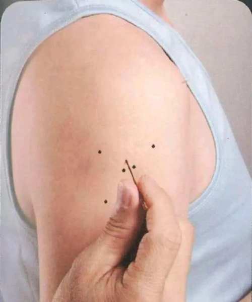 食物过敏按什么穴位