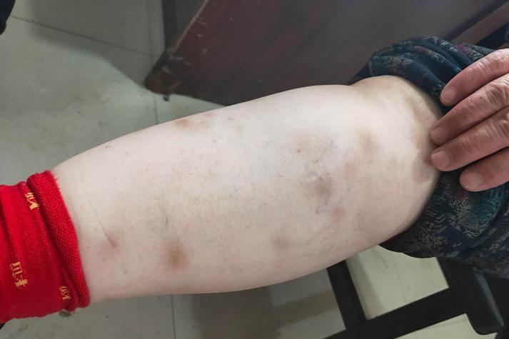 风湿性关节炎皮肤表现