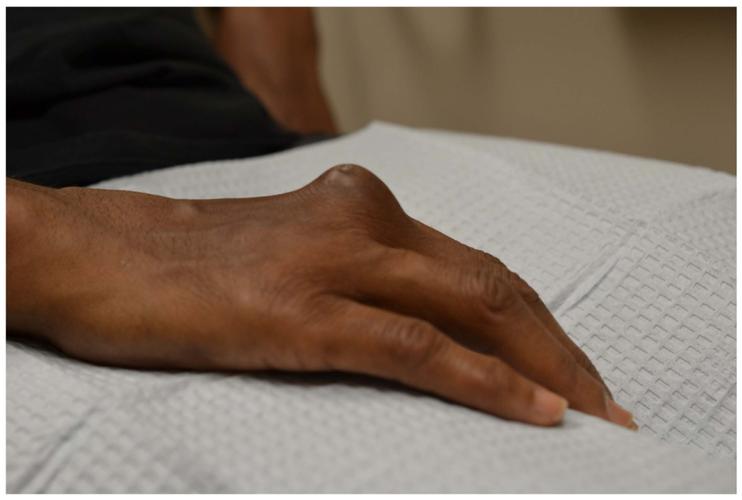 风湿性关节炎皮肤表现