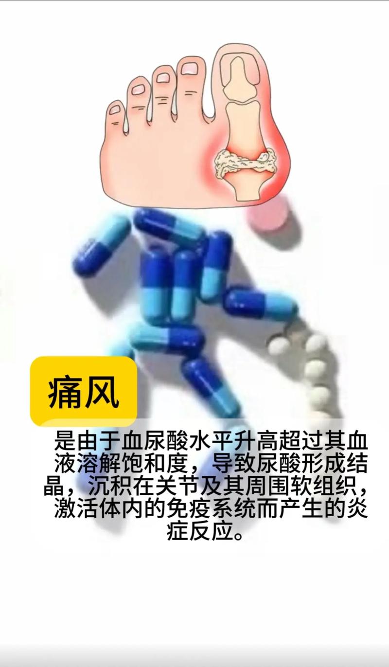 风湿关节炎脚肿怎么治