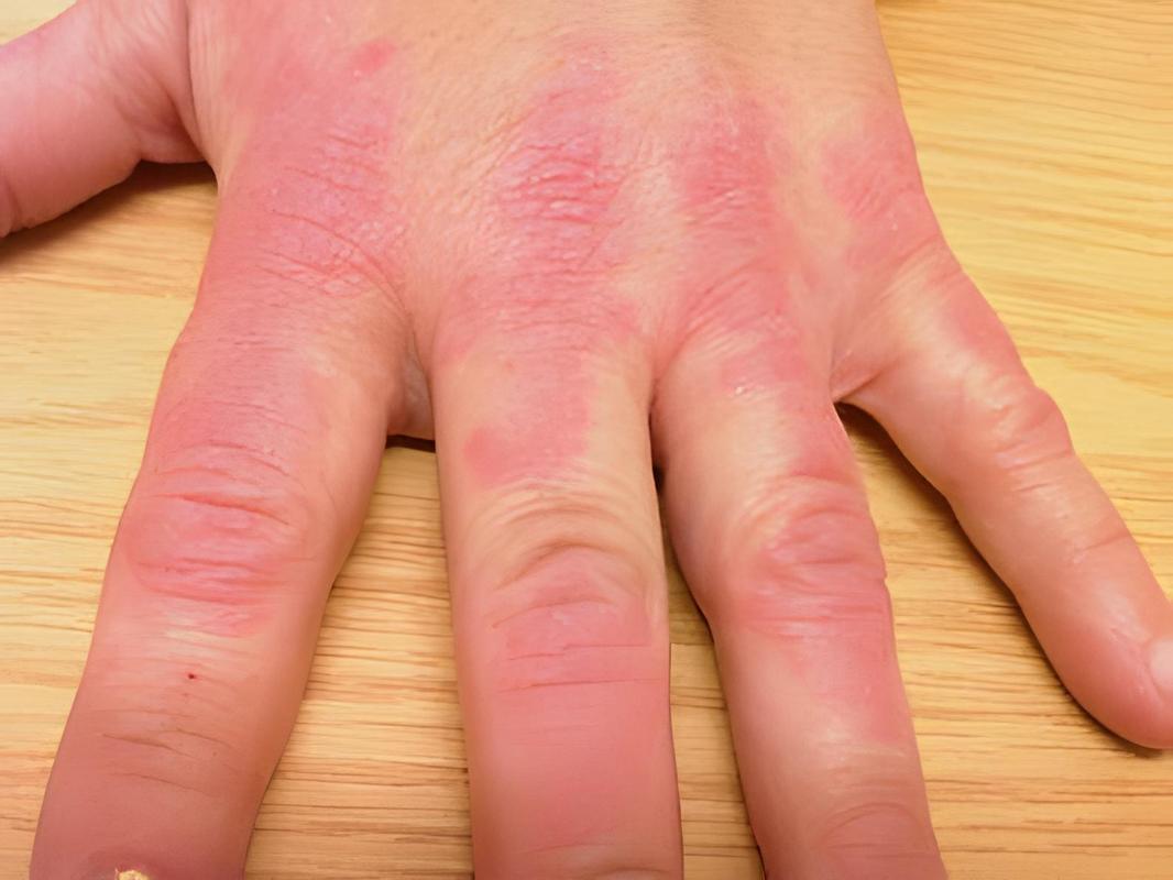 抗链o阳性是风湿病吗