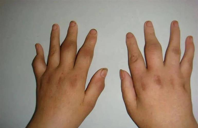 风湿性关节炎初期图片