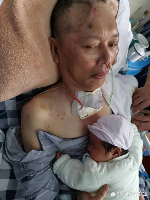 介入治疗脑梗形成脑疝