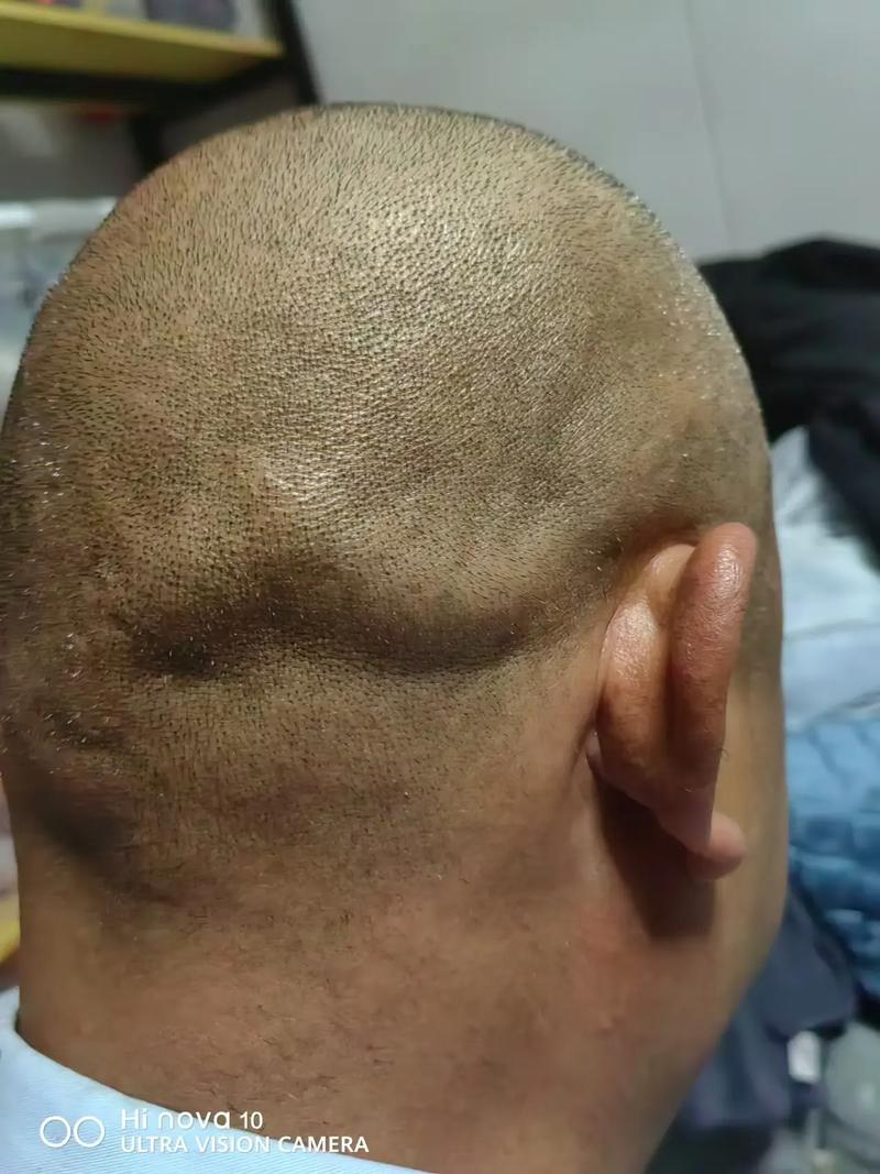 脑梗脑淤血是什么症状