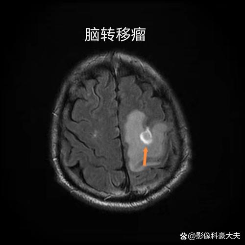 脑ct能查出脑梗治疗