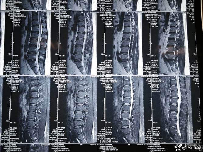 风湿性脊柱炎核磁共振