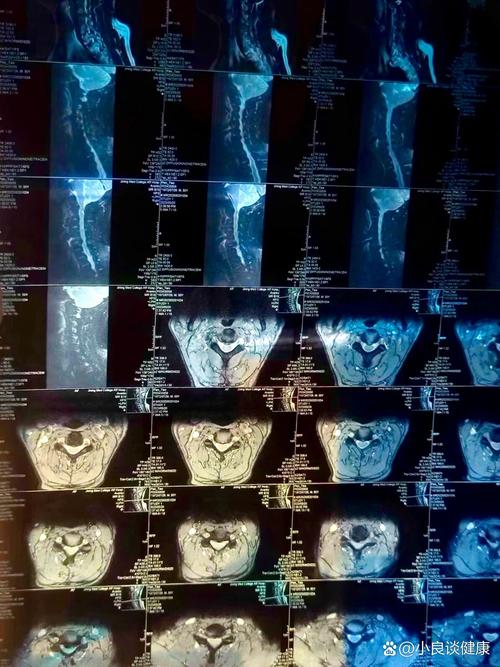 风湿性脊柱炎核磁共振
