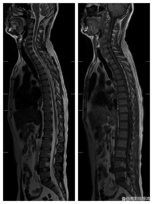 风湿性脊柱炎核磁共振