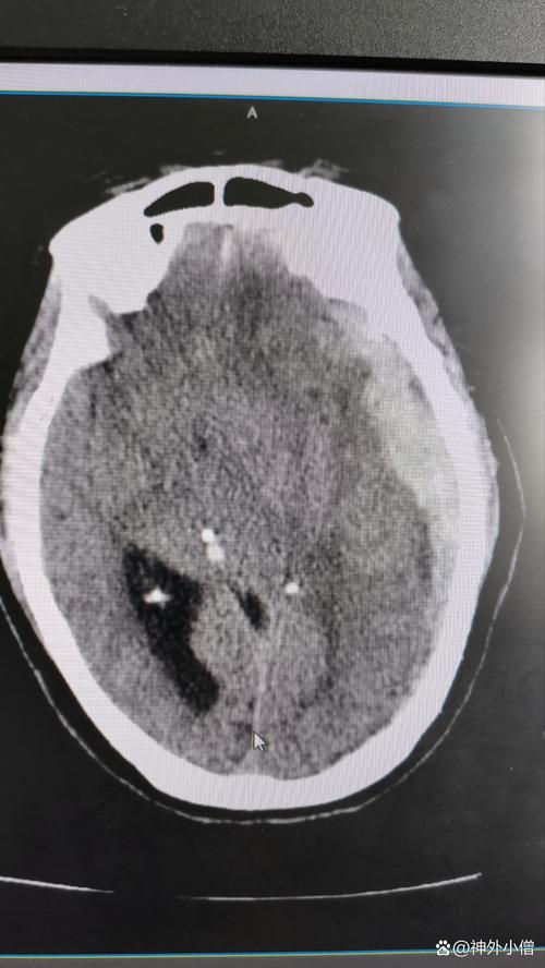 长春前卫医院脑血脑梗