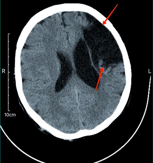 脑软化灶又是急性脑梗