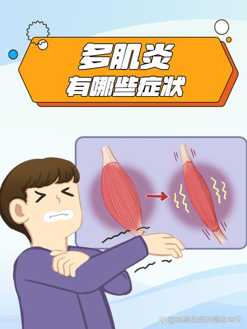 风湿性多肌痛挂什么科