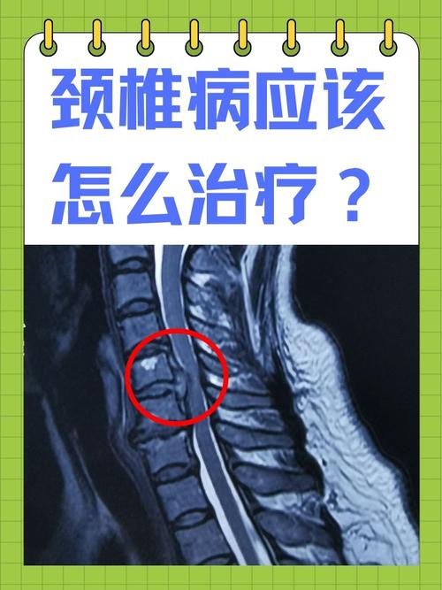 风湿瘀阻的颈椎病症状