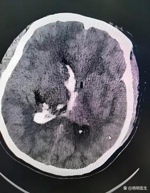 梗灶严重还是脑梗严重