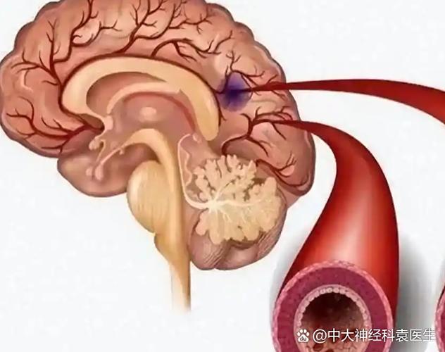 脑内多发缺血 脑梗灶