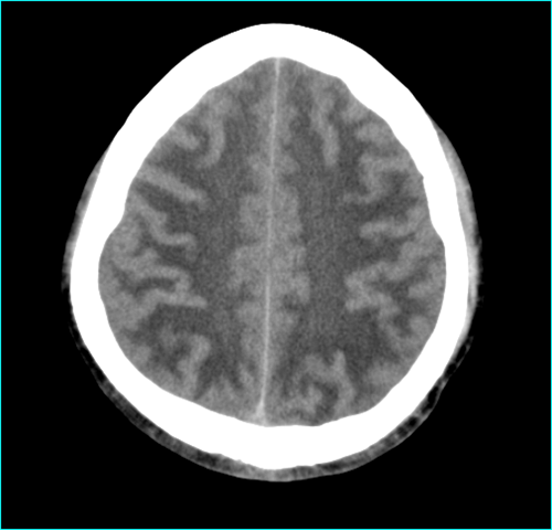 多发脑梗脑白质脱髓鞘