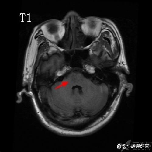 脑梗梗在脑桥上的危害