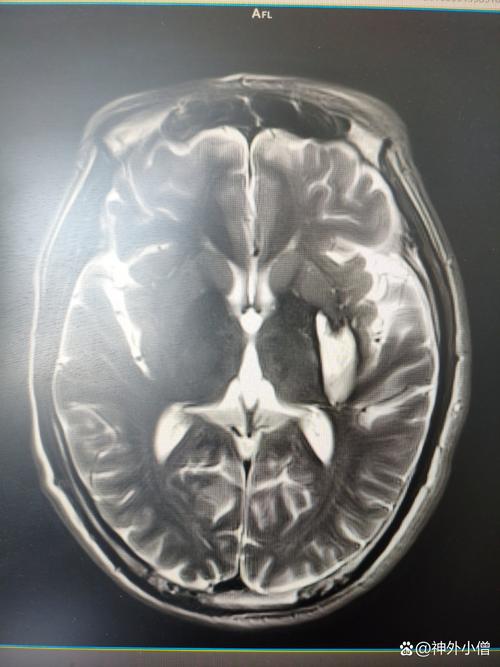 脑梗 脑内阿片样物质